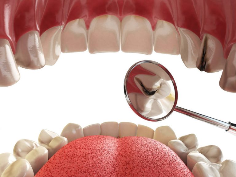 Las múltiples ventajas que te ofrecen las carillas dentales